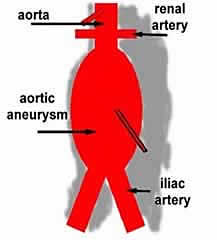 Abdominal Aortic Aneurysm
