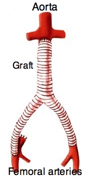 Aorto-bifemoral bypass