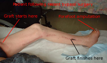 Femoro-popliteal bypass